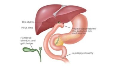Hepaticojejunostomy-5bdc653d-960w