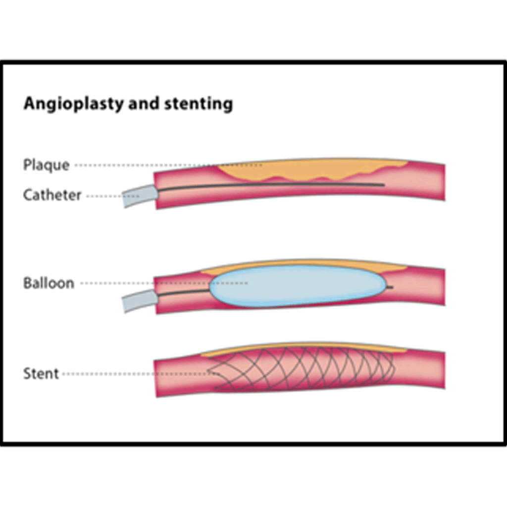 AngioplastNstenting01