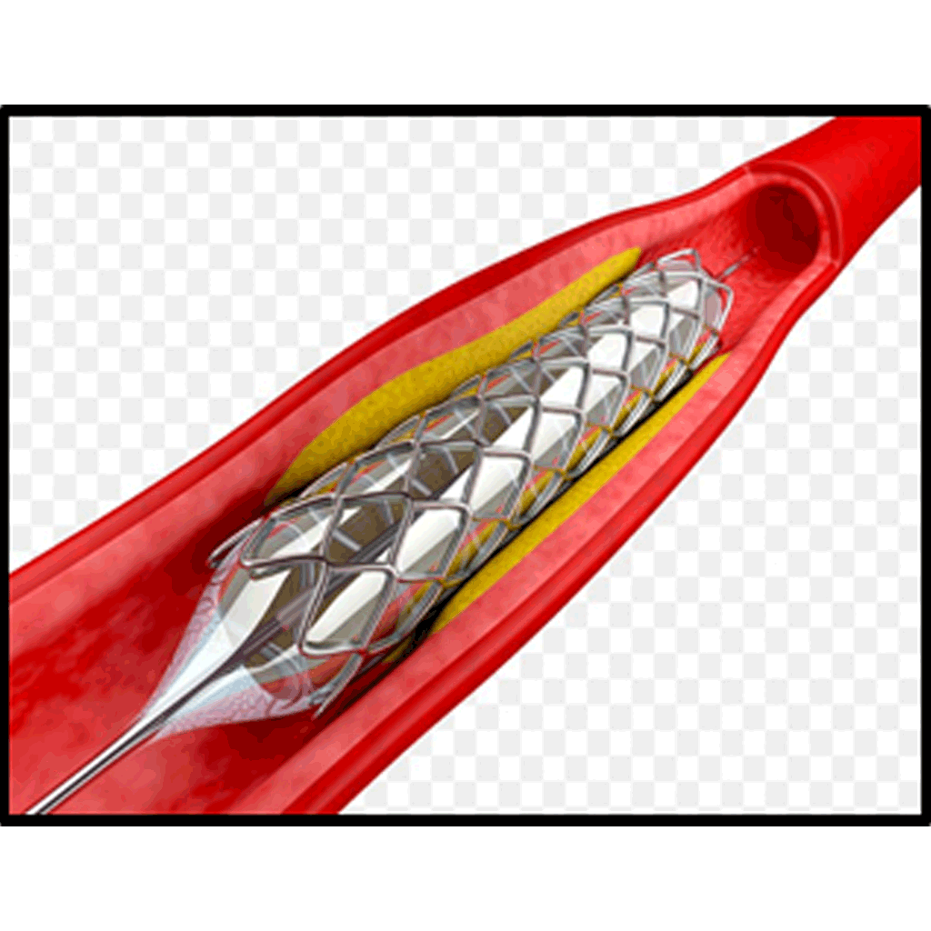 AngioplastNstenting02