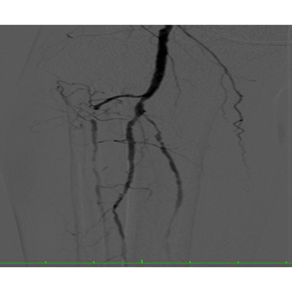 AngioplastNstenting03