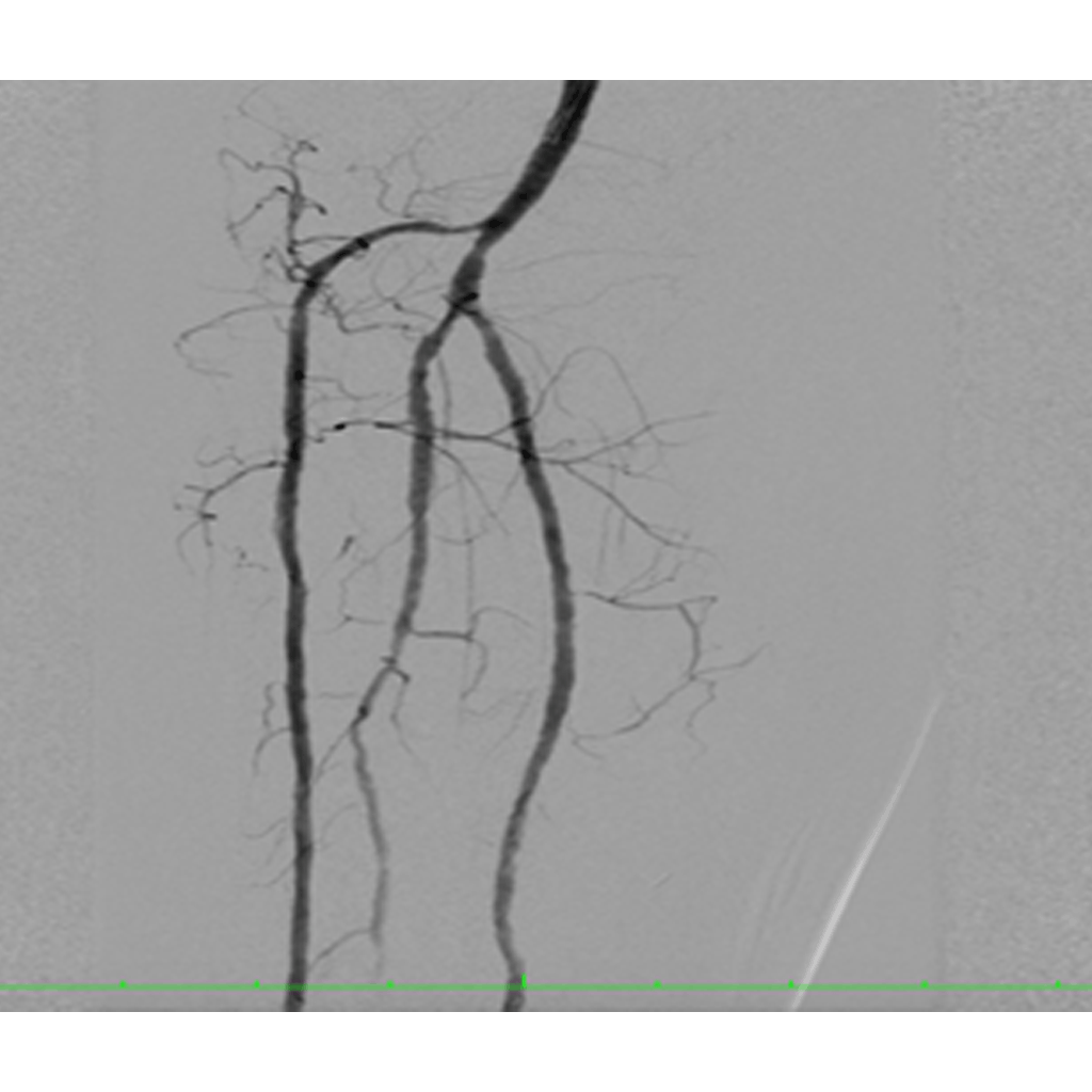 AngioplastNstenting04