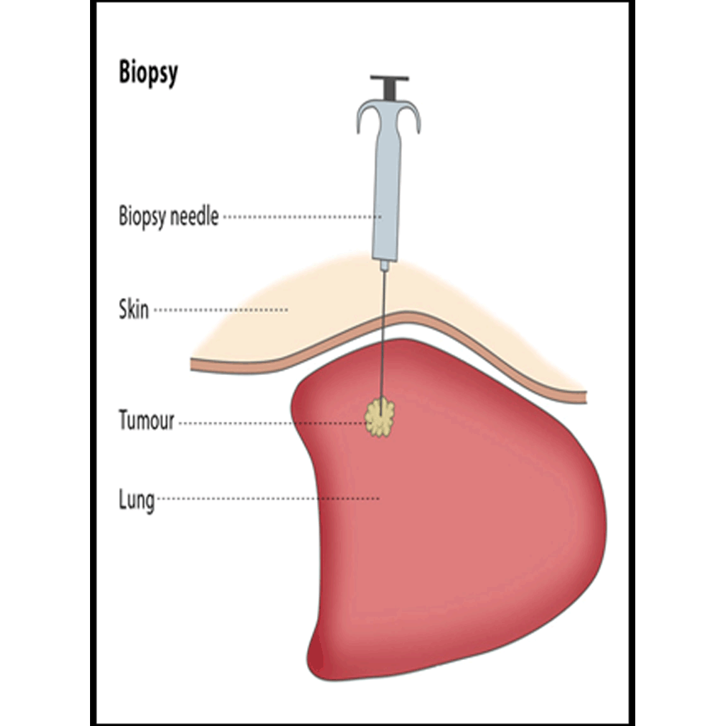 Biopsy01