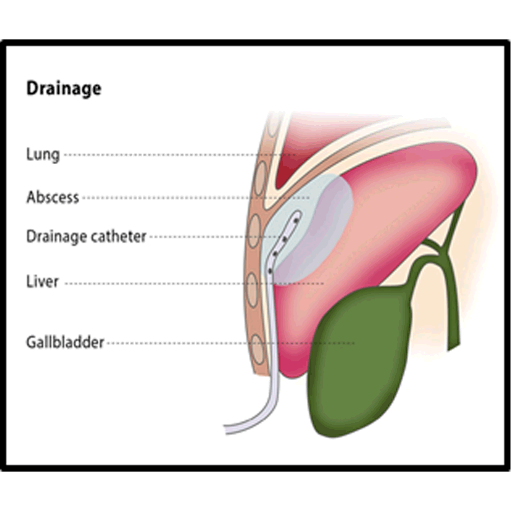 Drainage02