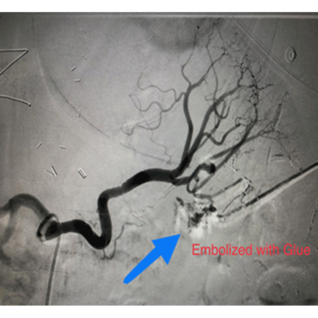EmbolisationGastrointestinalTB02