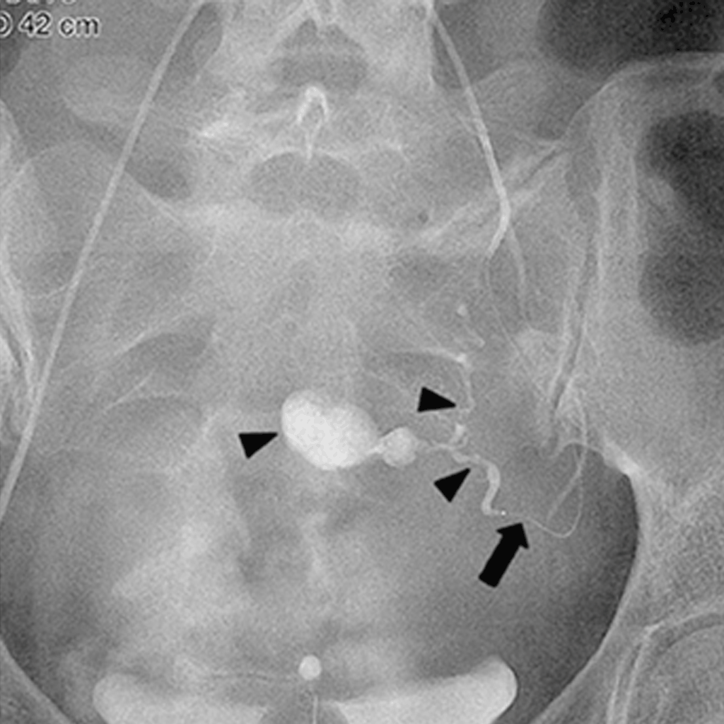 EmbolisationHaemorrhage02