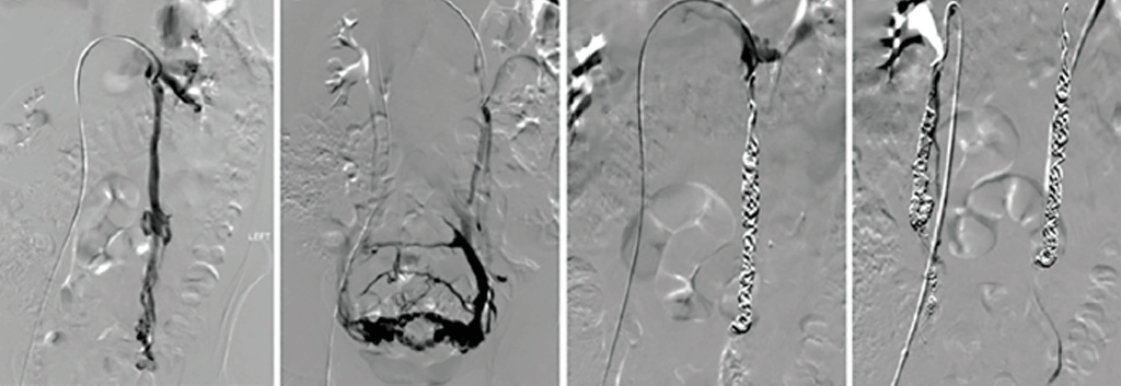 EmbolisationPelvicCS02