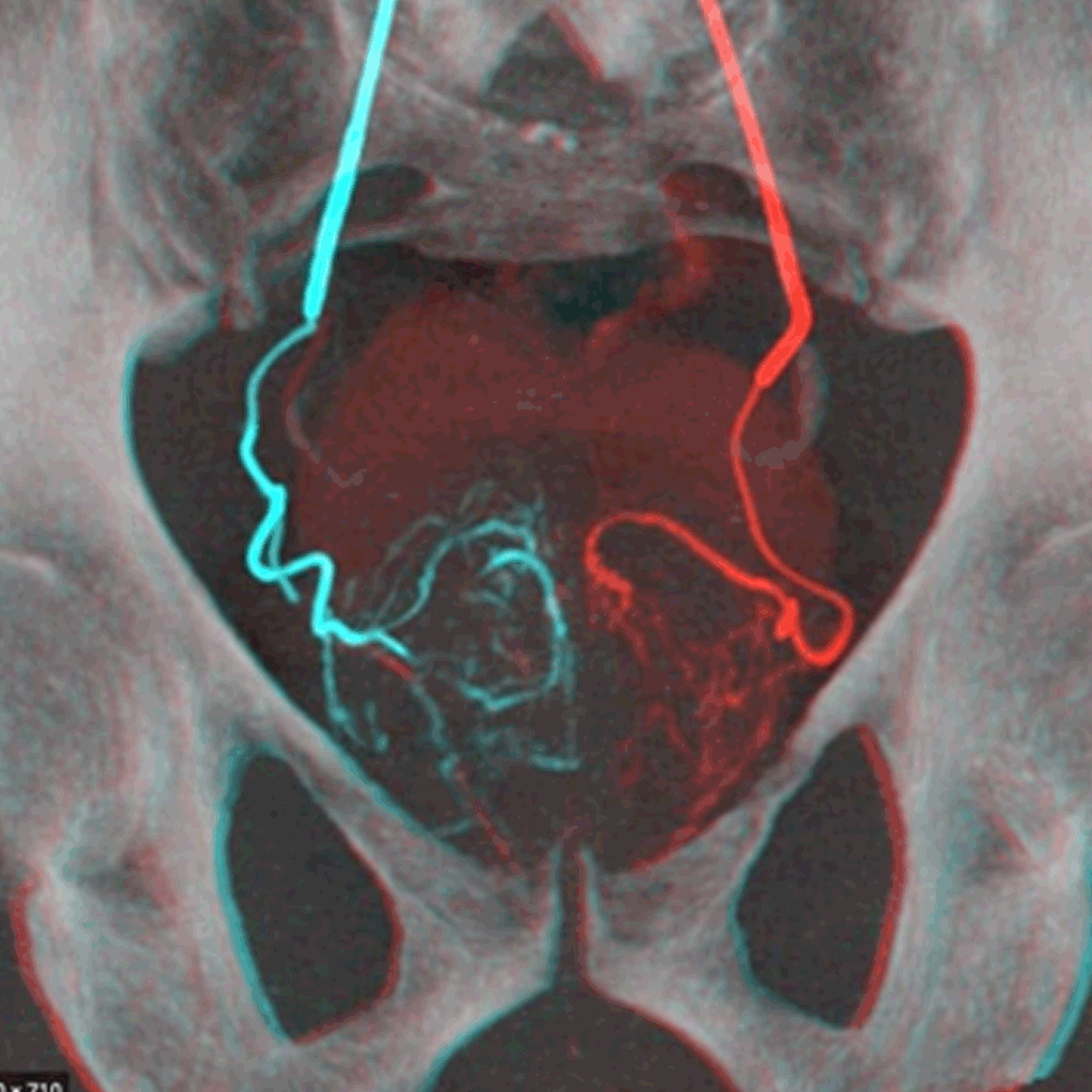 EmbolisationProstaticA01