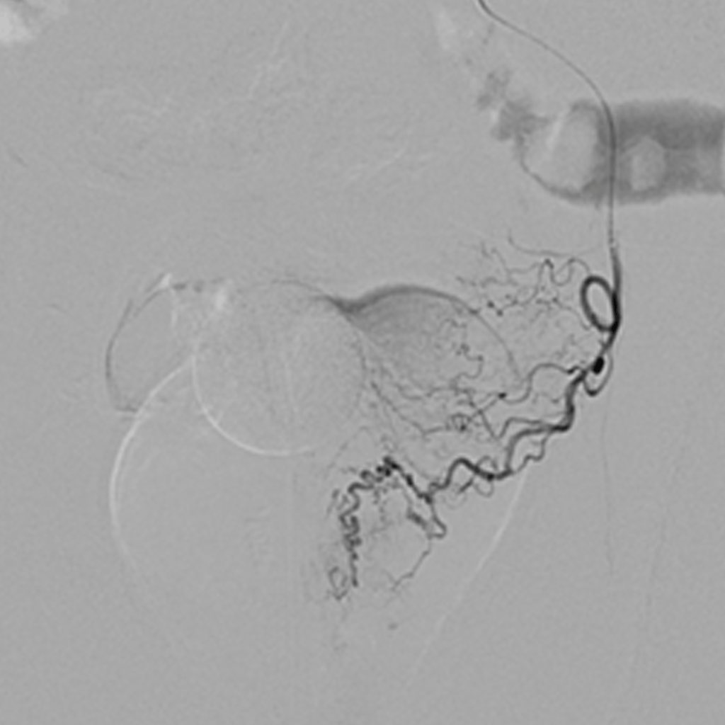 EmbolisationProstaticA02