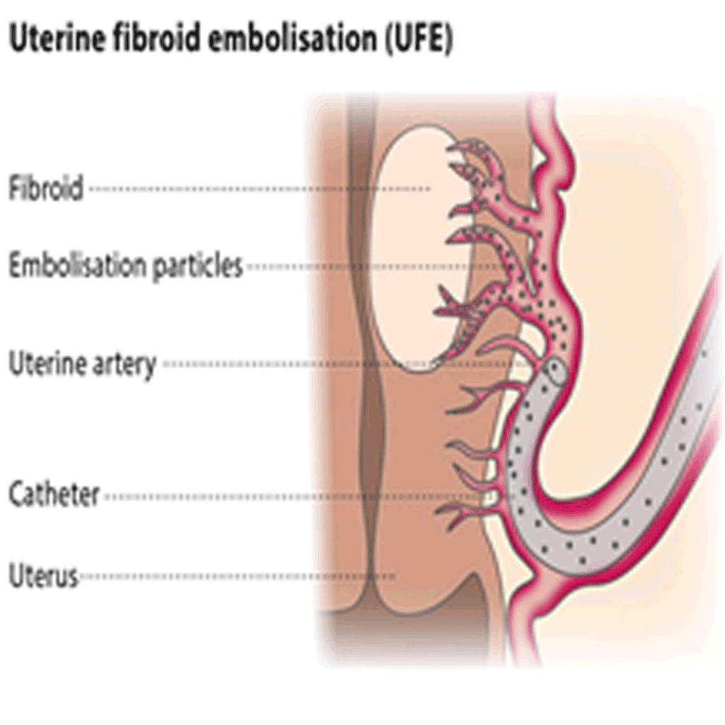 EmbolisationUterineFibroids02