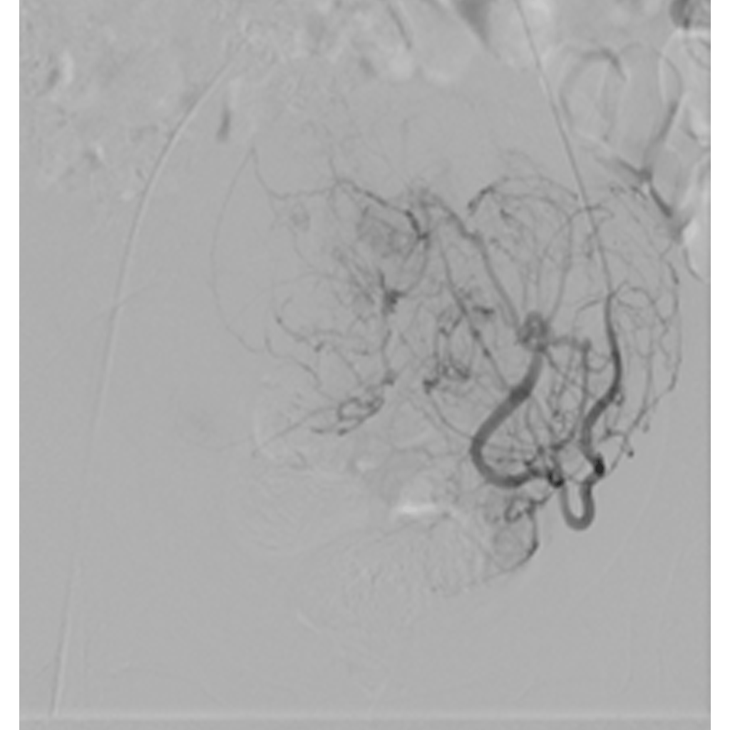 EmbolisationUterineFibroids03