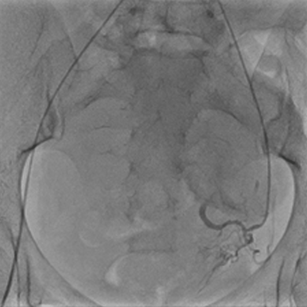 EmbolisationUterineFibroids04