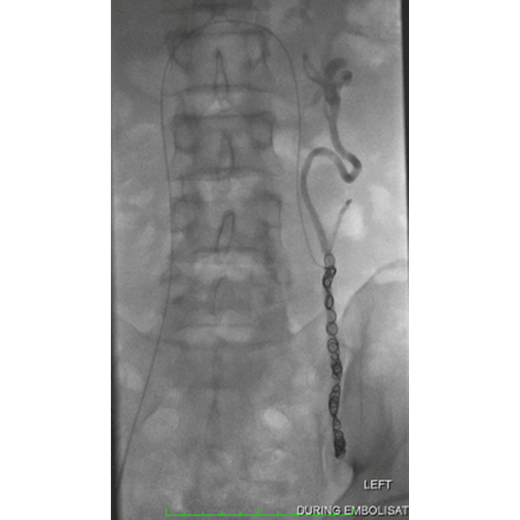 Embolisationvaricoceless01