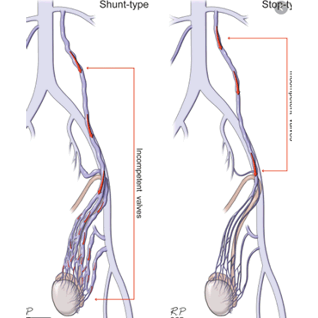 Embolisationvaricoceless02