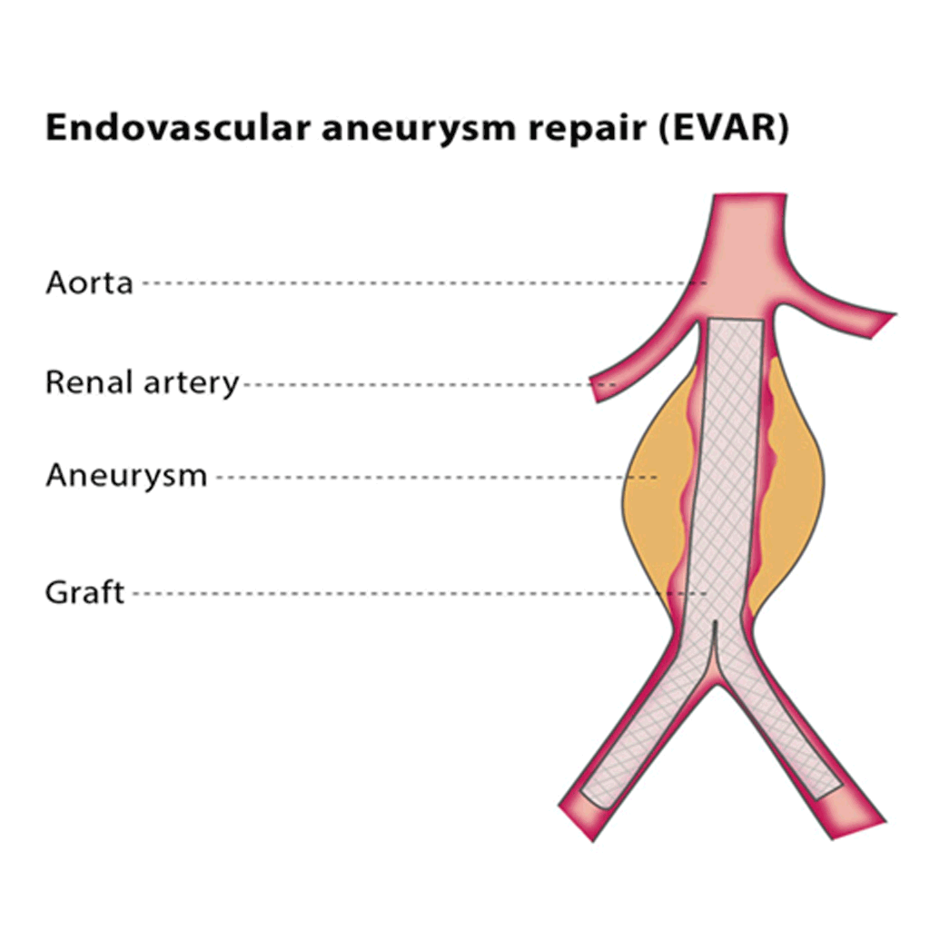 EndovascularAbdominalAA01