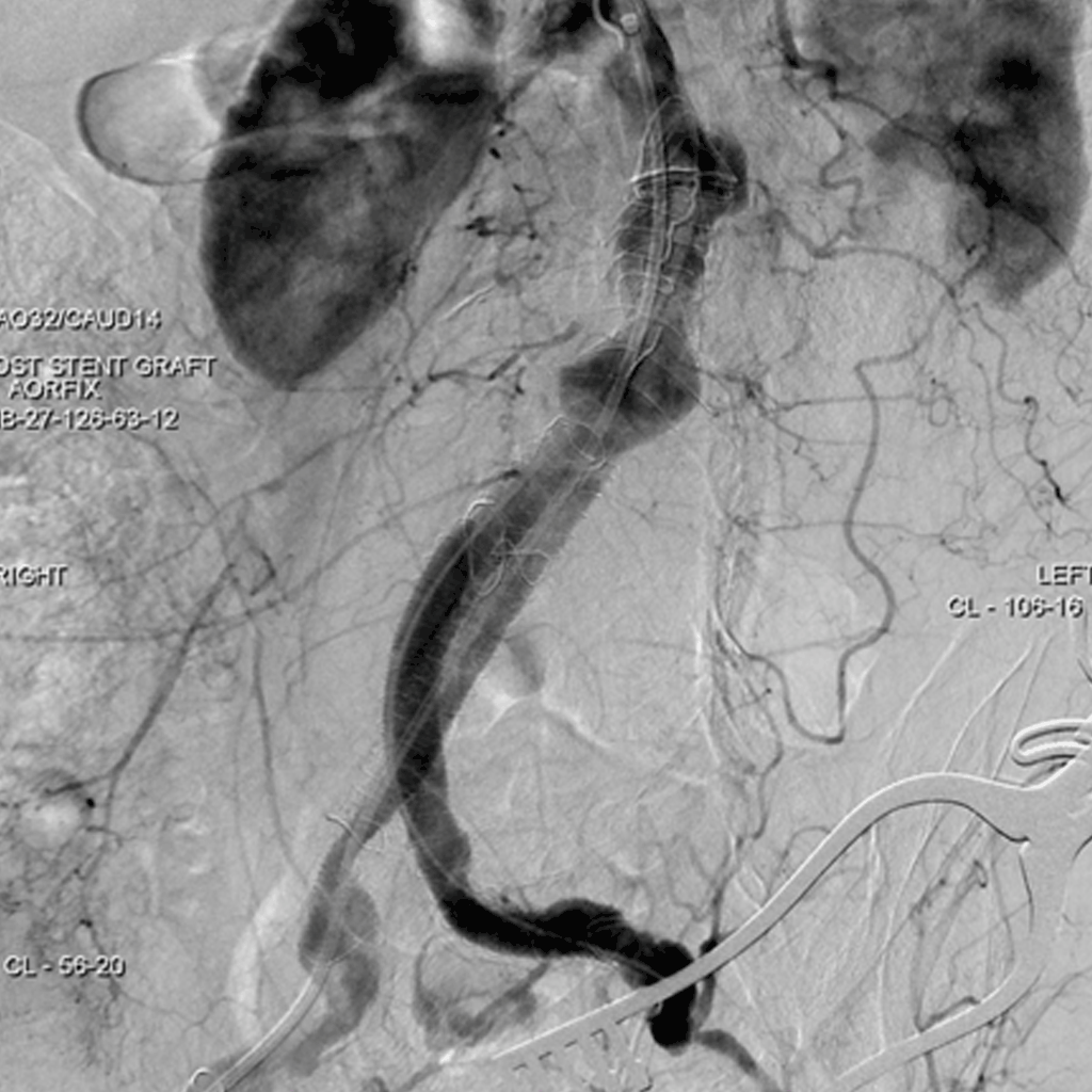 EndovascularAbdominalAA02