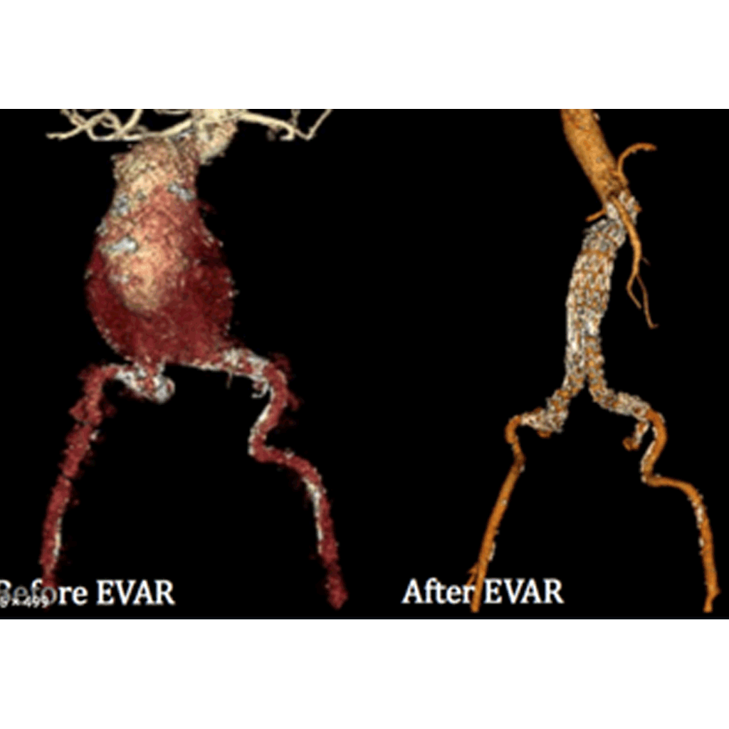 EndovascularAbdominalAA03