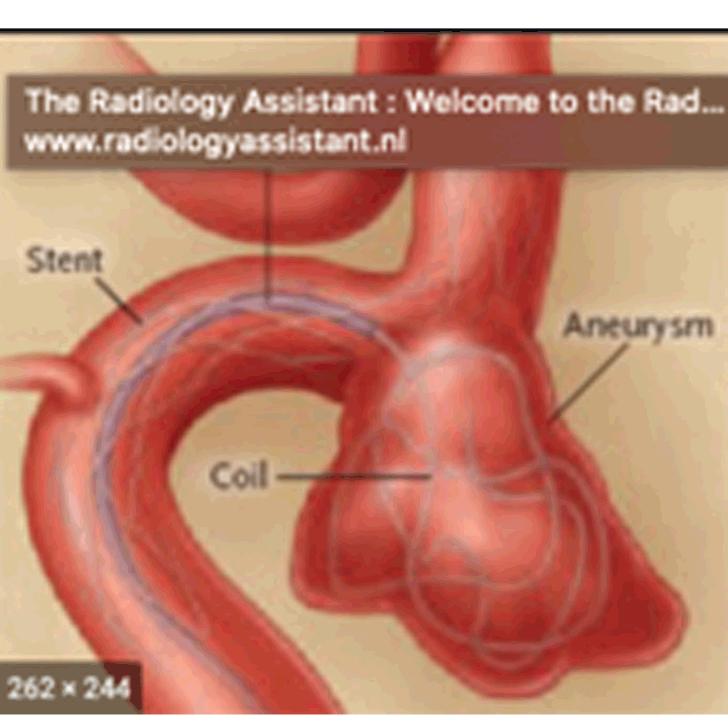 EndovascularAneurysms01