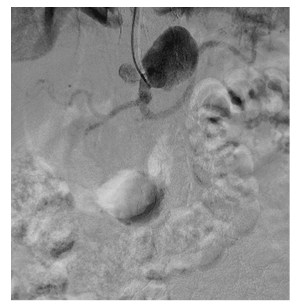 EndovascularAneurysms03