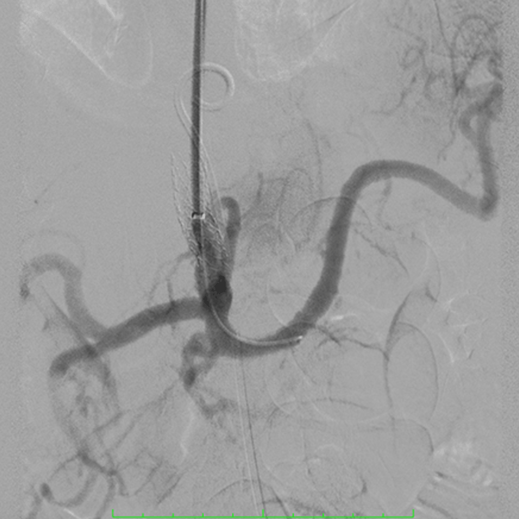 EndovascularAneurysms04