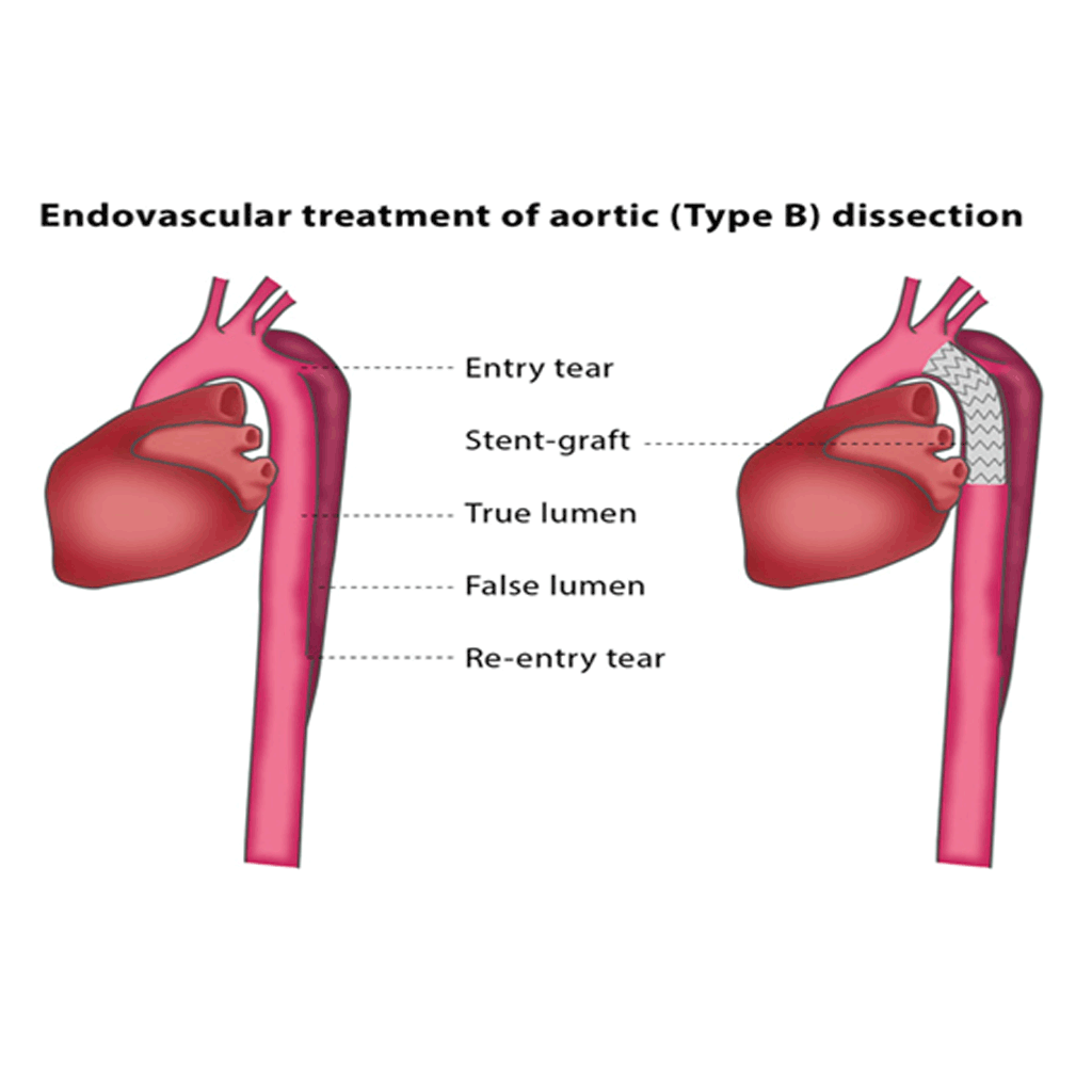 EndovascularAorticDissections01