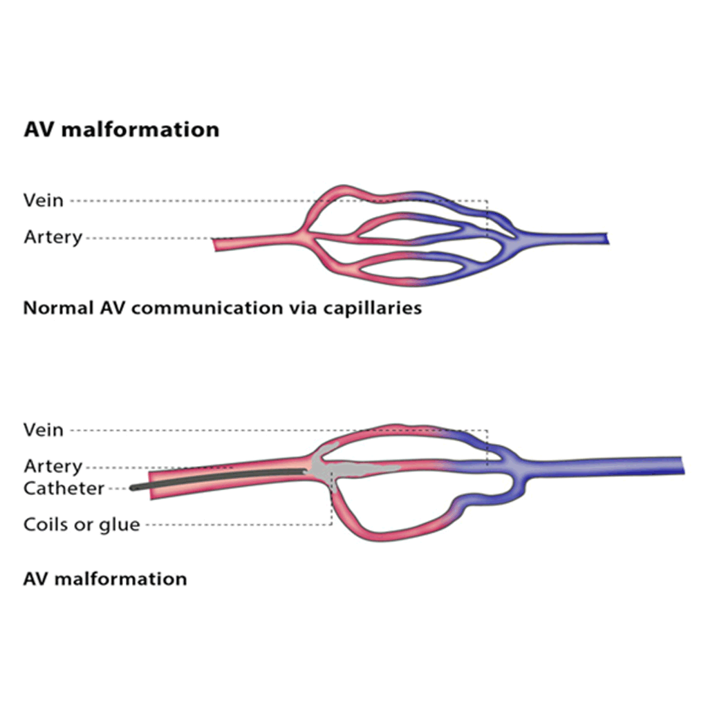 EndovascularArteriovenousM01