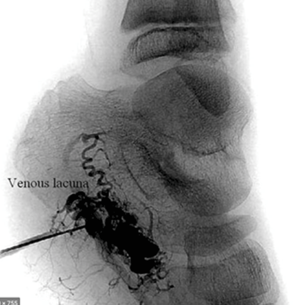 EndovascularArteriovenousM02