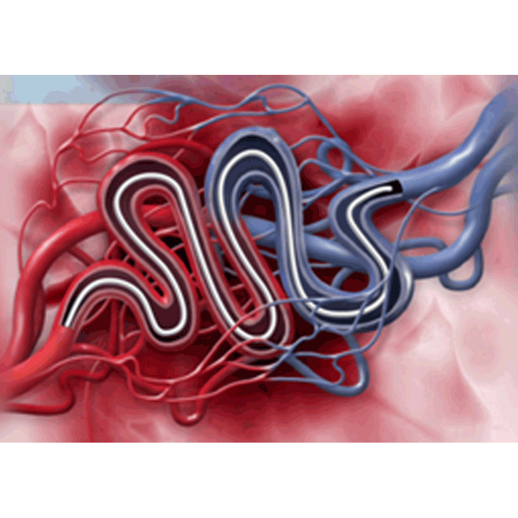 EndovascularArteriovenousM03