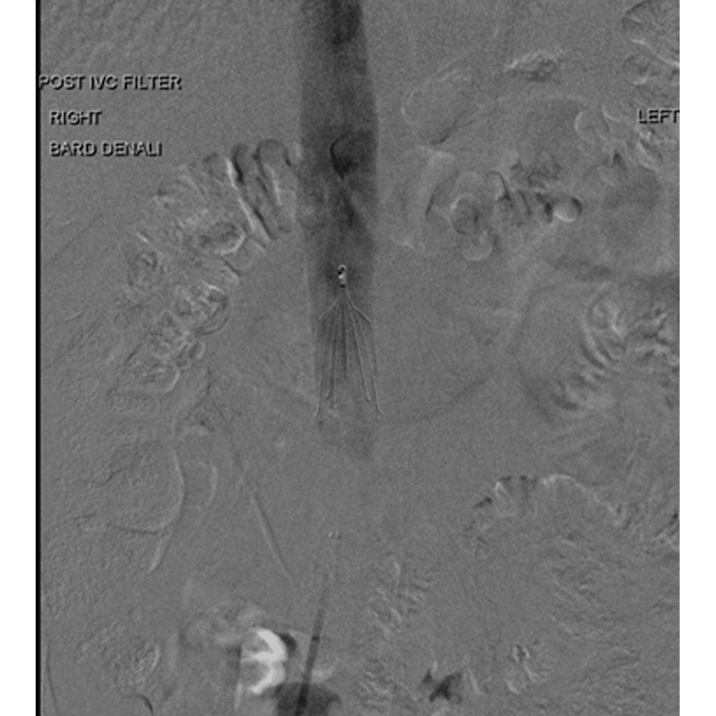 InferiorVenaCava02