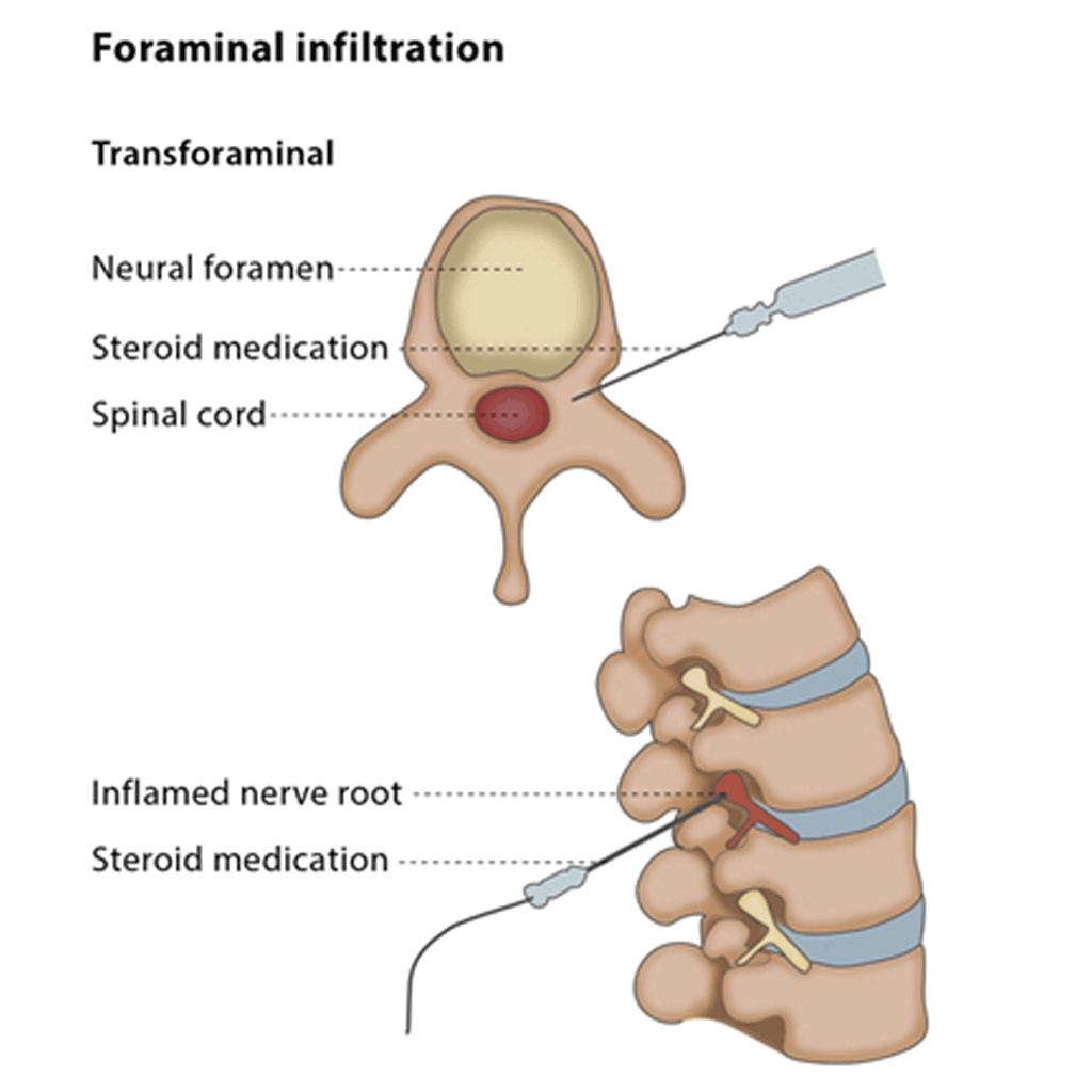 InfiltrationsGI01