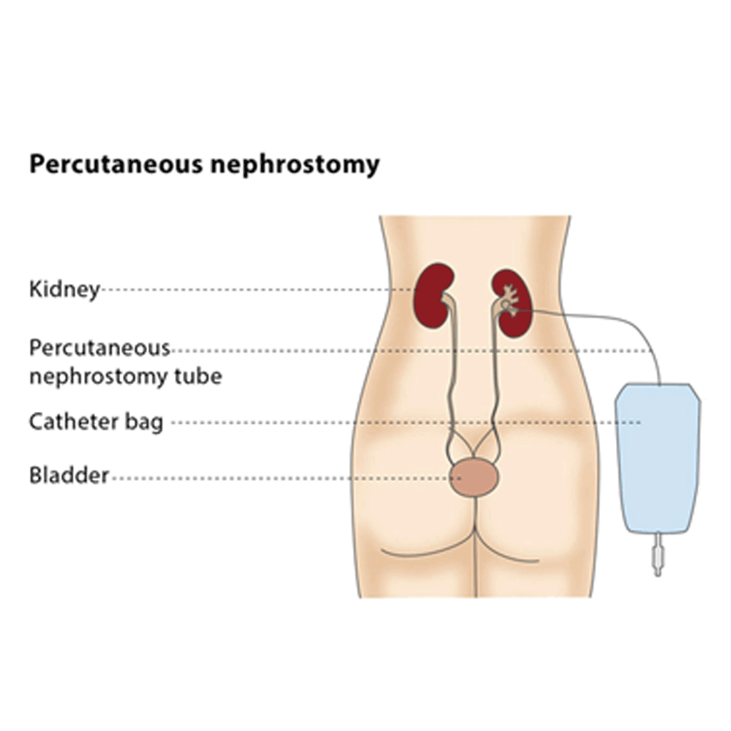 Nephrostomy01
