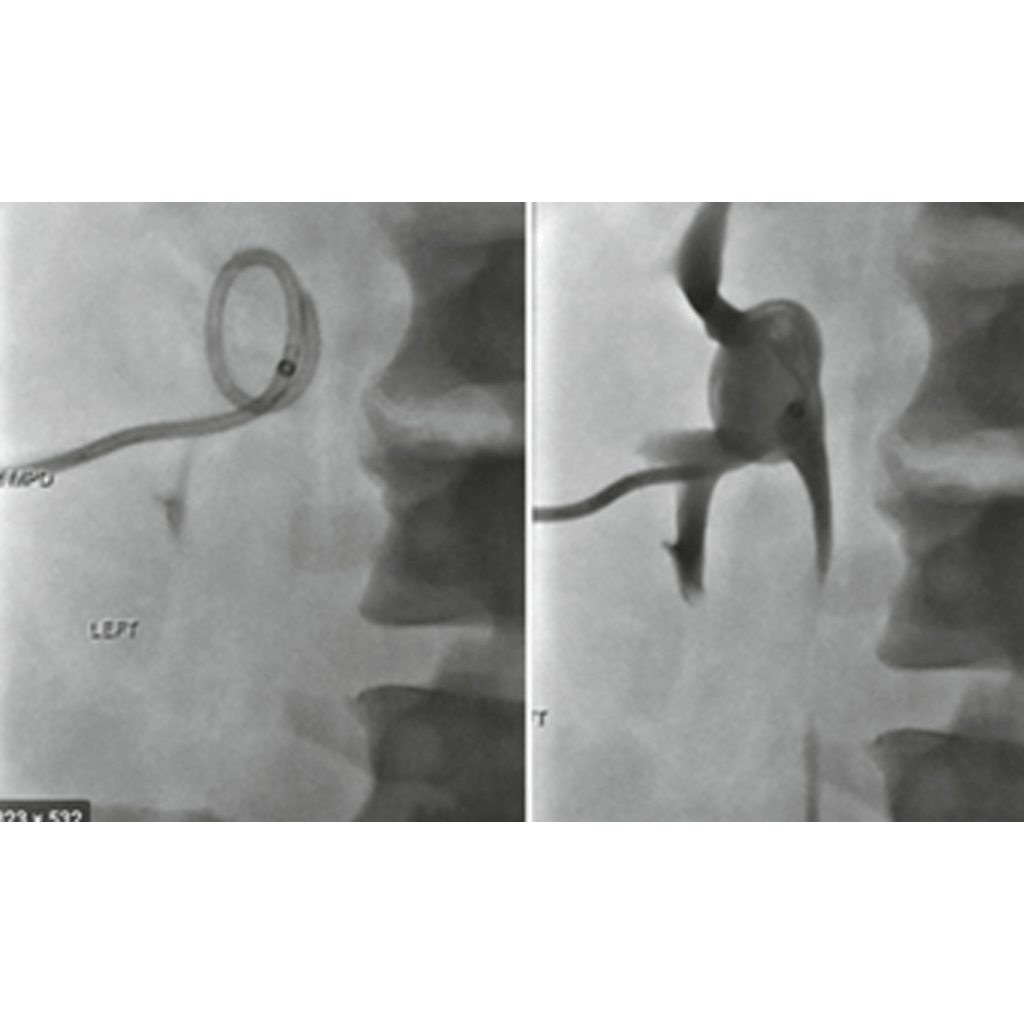 Nephrostomy02