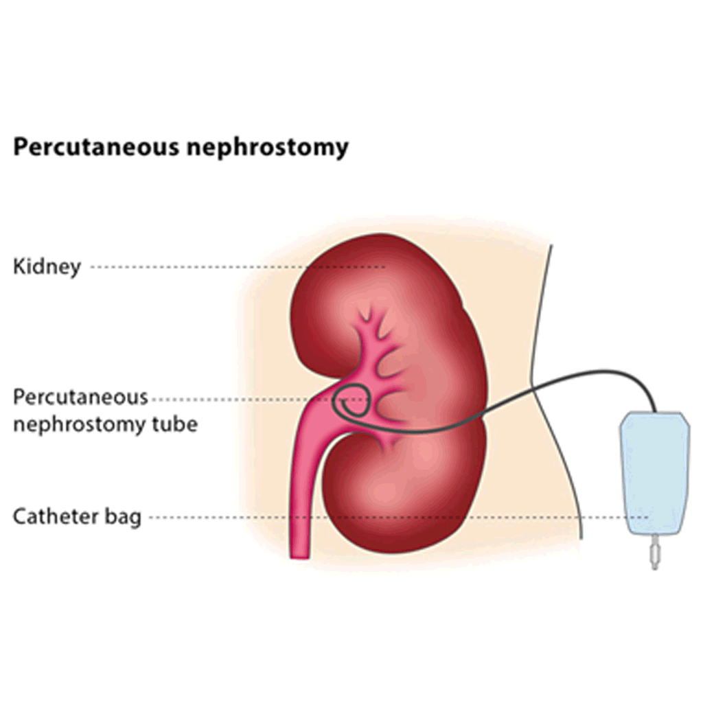 Nephrostomy03