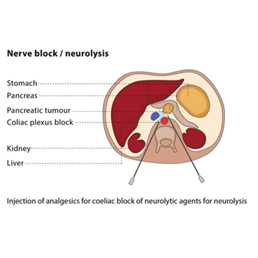 Neurolysis01