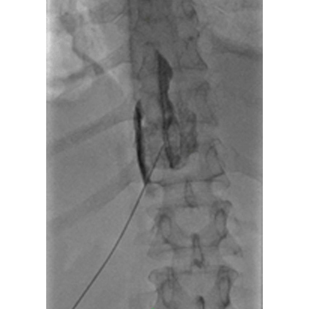 Neurolysis03