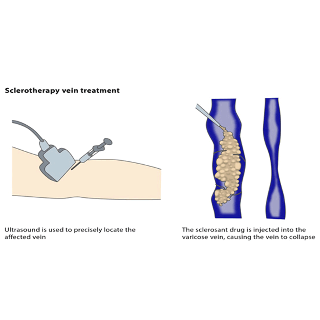 Sclerotherapy01