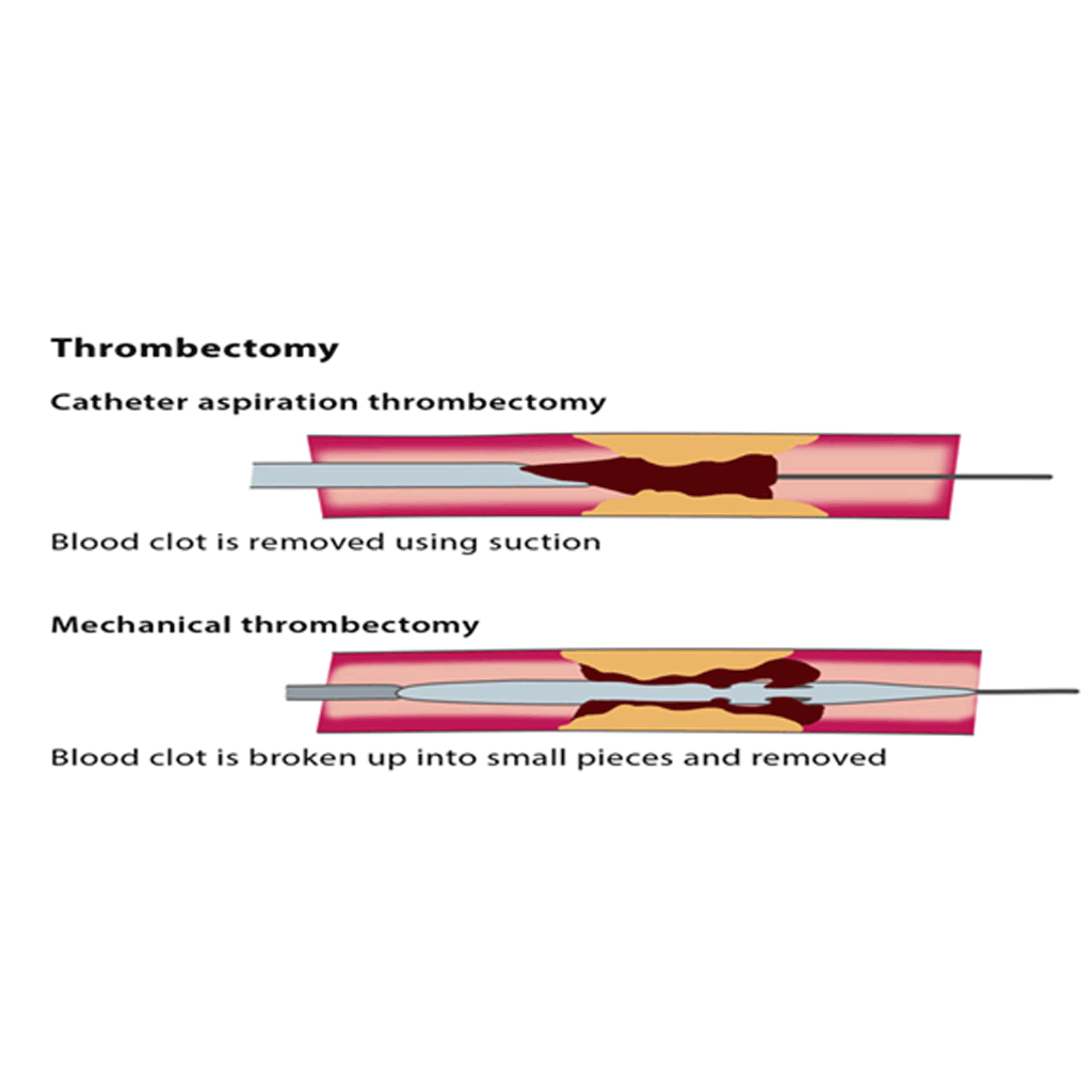 Thrombectomy02