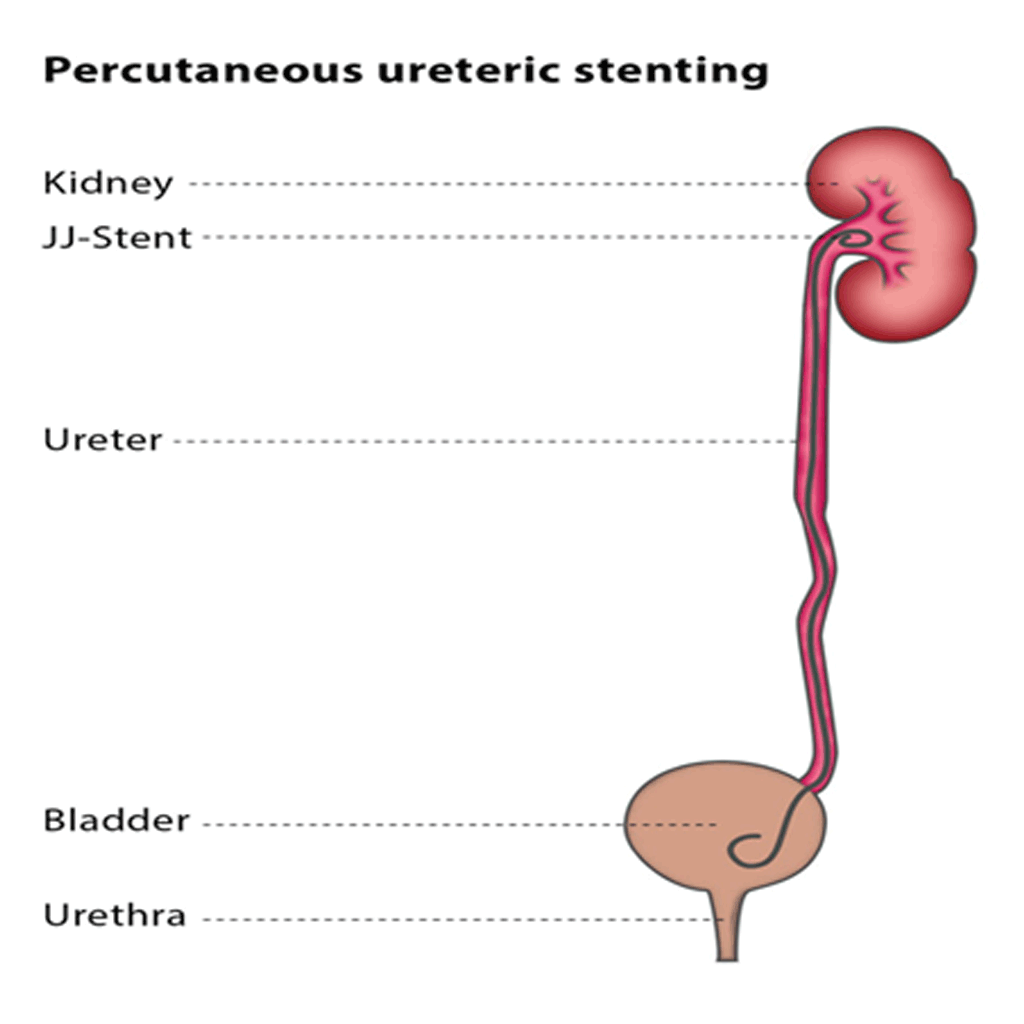UretericStenting