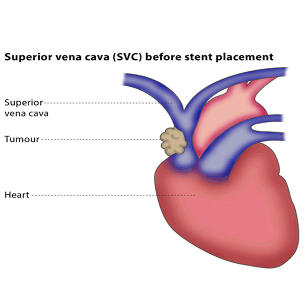 VenaCavaStenting01