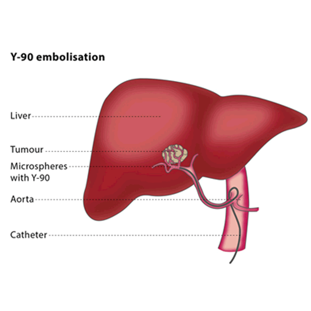 Y-90_radioembolisation01