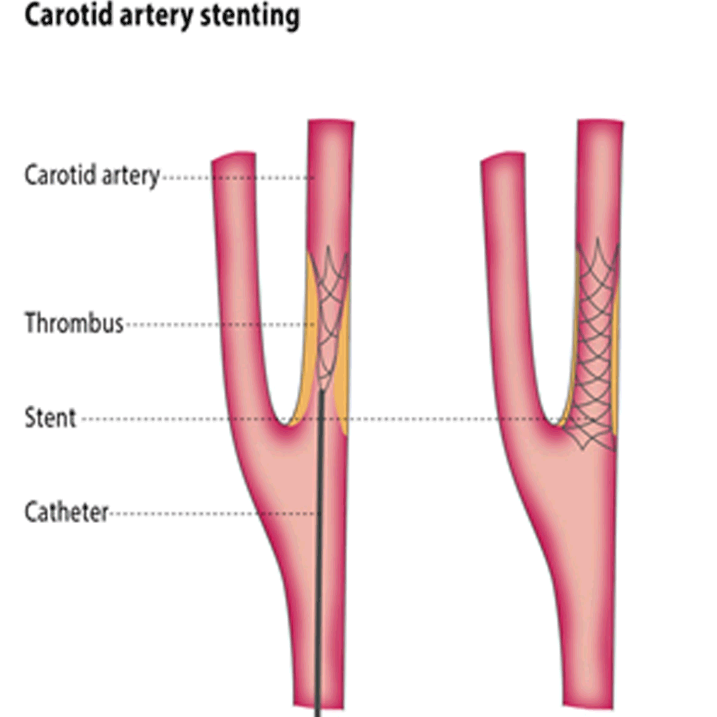 carotidArteryStenting01