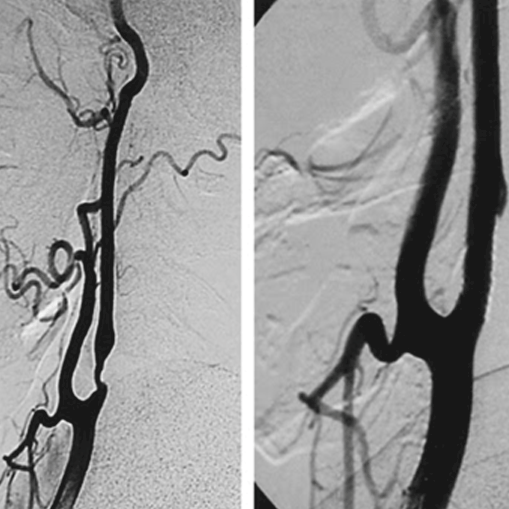 carotidArteryStenting02