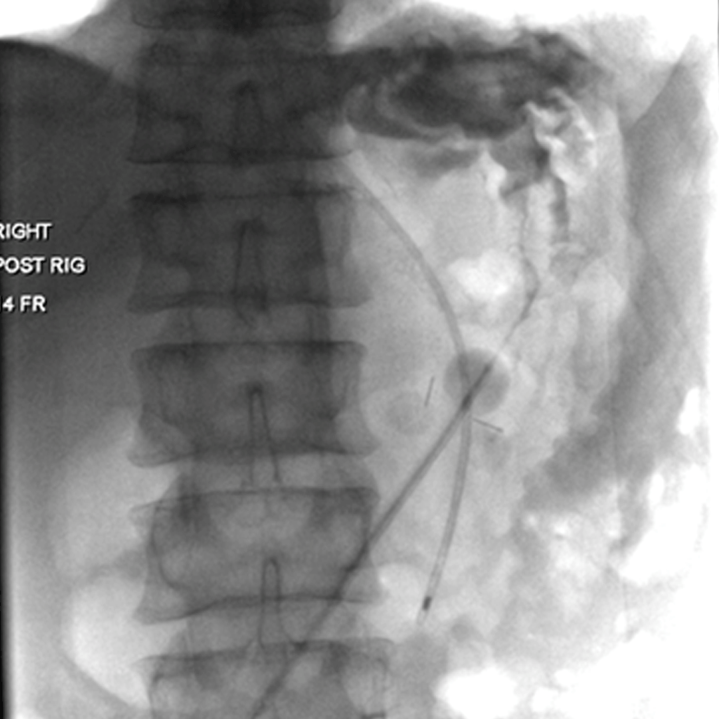 gastrostomy01