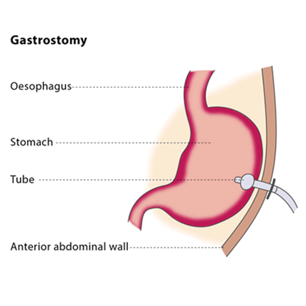 gastrostomy02