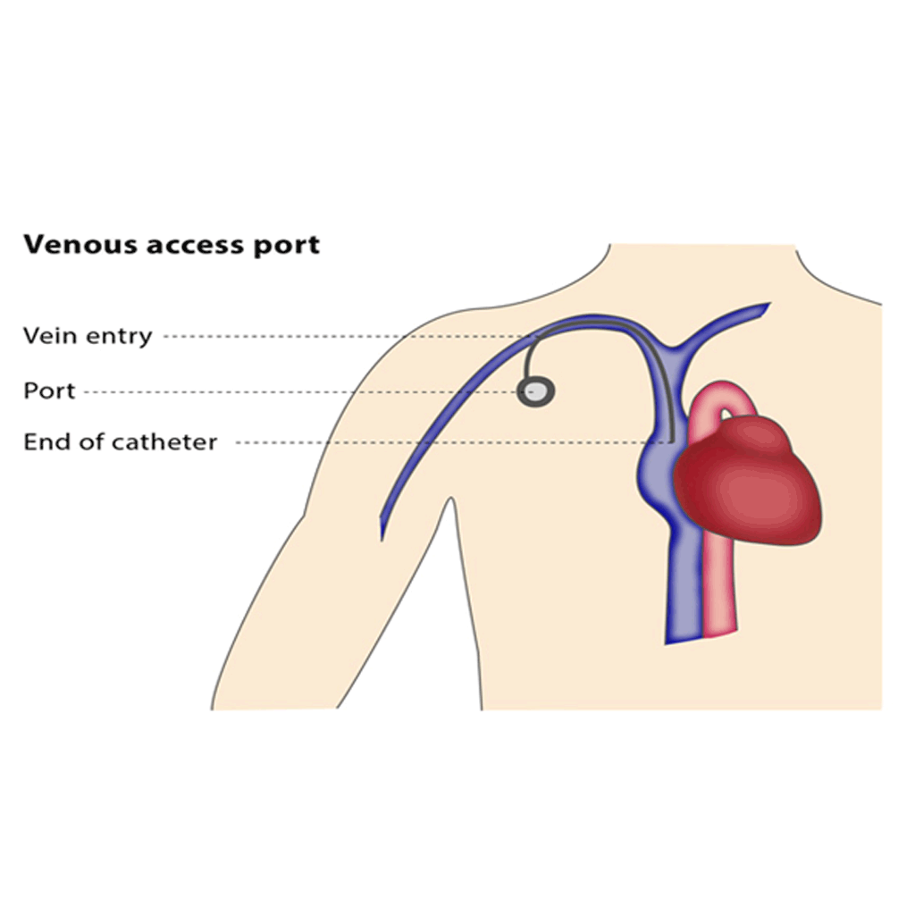 venousAccessPort01